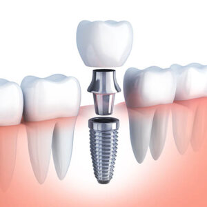 Single Tooth Implant