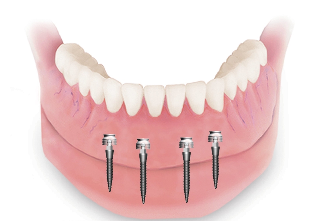 Implant-Supported-Prosthesis-denture treatment