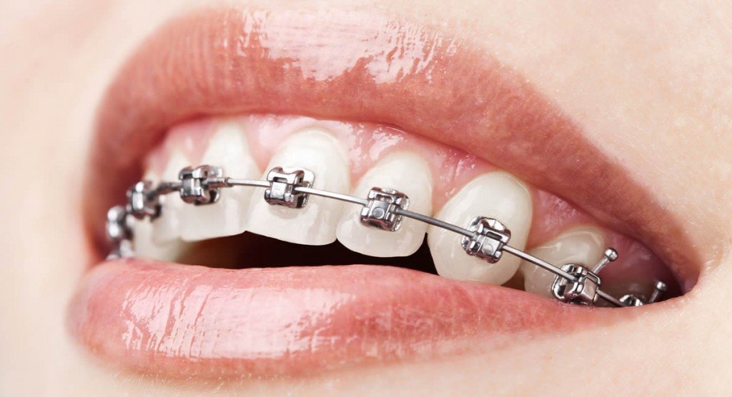 Braces-in-gurgaon