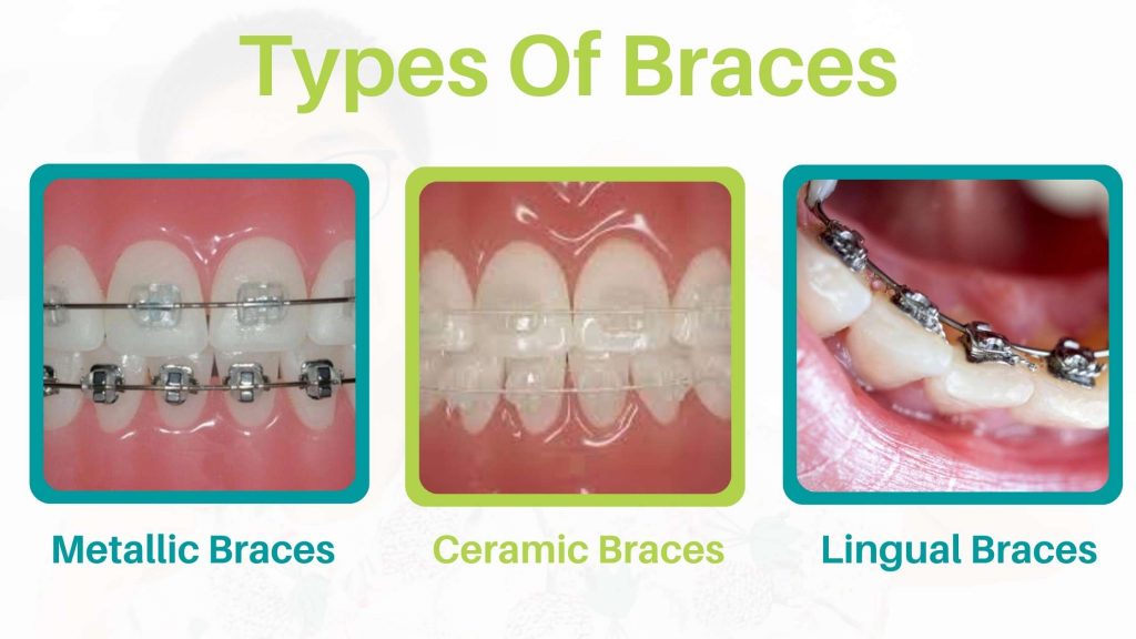 Traditional Braces Cost In Dwarka India