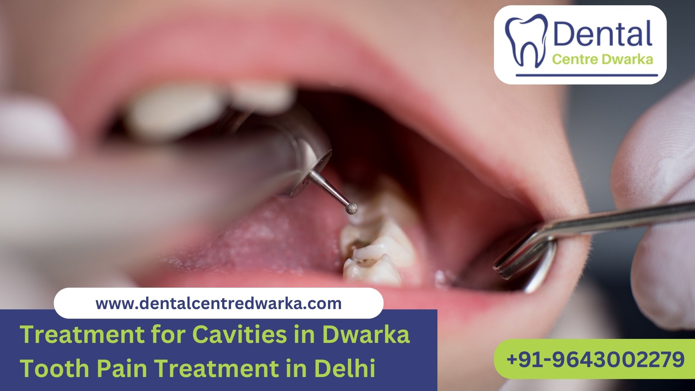 You are currently viewing Treatment for Cavities in Dwarka | Tooth Pain Treatment