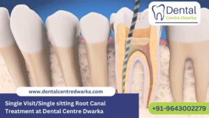 Read more about the article Single sitting Root Canal Treatment in Dwarka